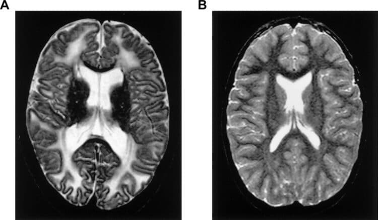 Top Rarest Diseases In The World The Second Angle