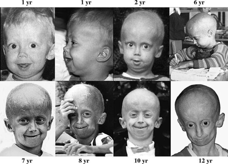 Top Rarest Diseases In The World The Second Angle