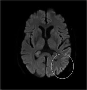 Alice in Wonderland Syndrome- A Rare and Real Mental Health Condition
