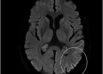 Alice in Wonderland Syndrome- A Rare and Real Mental Health Condition