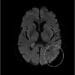 Alice in Wonderland Syndrome- A Rare and Real Mental Health Condition