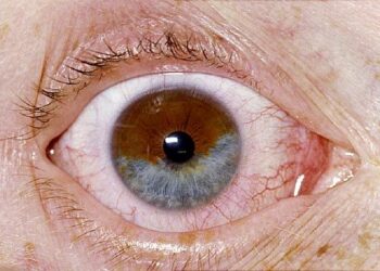 5 rare eye conditions you didn’t know existed
