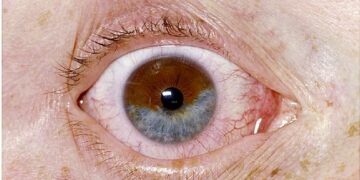 5 rare eye conditions you didn’t know existed