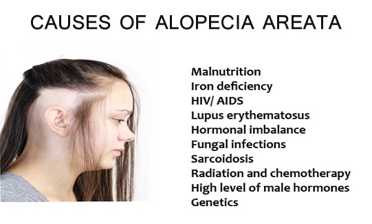 Everything you need to know about Alopecia areata: