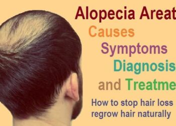 Everything you need to know about Alopecia areata: