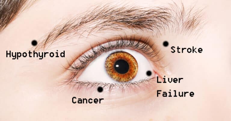 5-rare-eye-conditions-you-didn-t-know-existed-the-second-angle