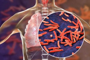 Lockdown Lifestyle Risks Youth of Tuberculosis Infections