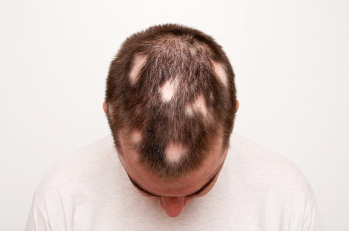 Everything you need to know about Alopecia areata: