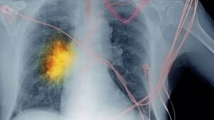 Everything You Need To Know About lung cancer- Overview, Symptoms, and Treatment