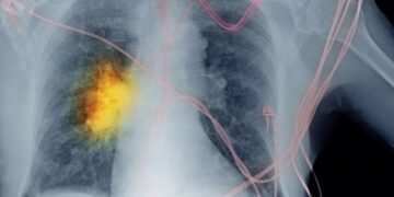 Everything You Need To Know About lung cancer- Overview, Symptoms, and Treatment