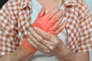 10 Home Remedies to Ease the Pain of Arthritis