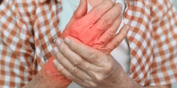 10 Home Remedies to Ease the Pain of Arthritis