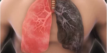 Everything You Need To Know About lung cancer- Overview, Symptoms, and Treatment