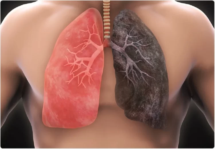 Everything You Need To Know About lung cancer- Overview, Symptoms, and Treatment
