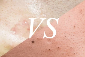 Whiteheads vs Blackheads: What’s the Difference?