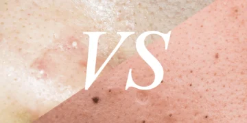 Whiteheads vs Blackheads: What’s the Difference?