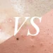 Whiteheads vs Blackheads: What’s the Difference?