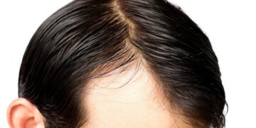 Look Like Peyton Manning? How to Sack Your Receding Hairline