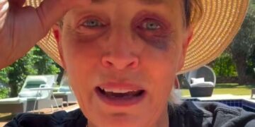 Sharon Stone Shows Off Shiner To Reassure Concerned Fans: ‘I Know You’re All Worried’